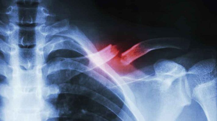 La mañana - La falta de minerales: calcio y magnesio