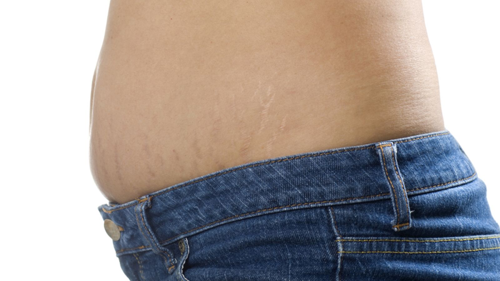 Saber vivir - Estrías y varices