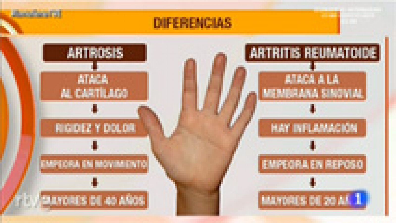Los consejos de Saber vivir - Articulaciones y huesos fuertes - Artrosis y artritis de mano
