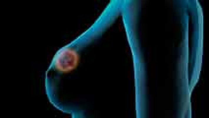Bala Mágica': Tratamiento contra el cáncer de mama