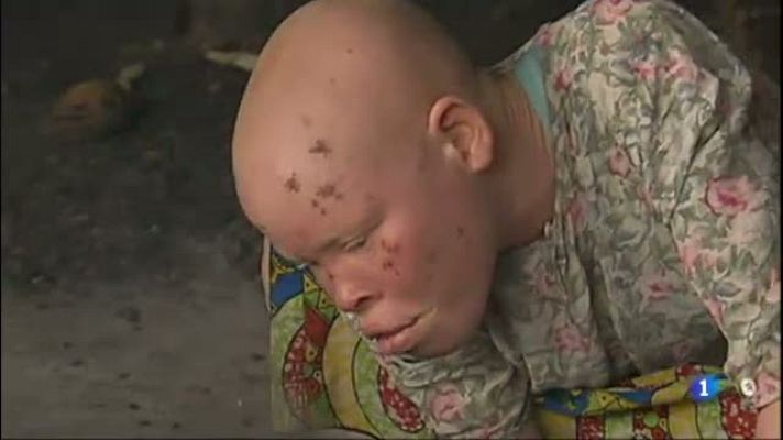 L'Informatiu - Dermatòlegs catalans aprofiten les vacances per lluitar contra l'albinisme a l'Àfrica