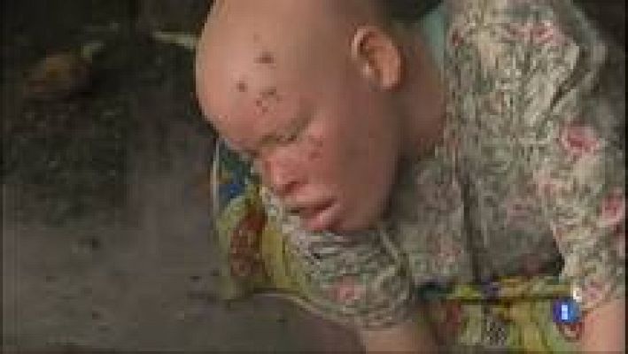 L'Informatiu - Dermatòlegs catalans aprofiten les vacances per lluitar contra l'albinisme a l'Àfrica