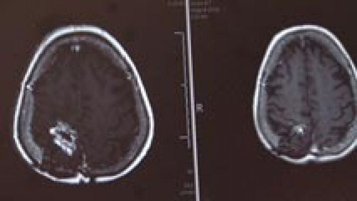 Telediario 1 - Demuestran la eficacia de un fármaco contra los glioblastoma