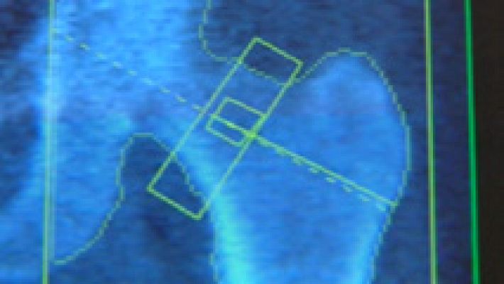 Telediario 1 - La empresa Traiber está siendo investigada por vender prótesis caducadas que se implantaban a pacientes