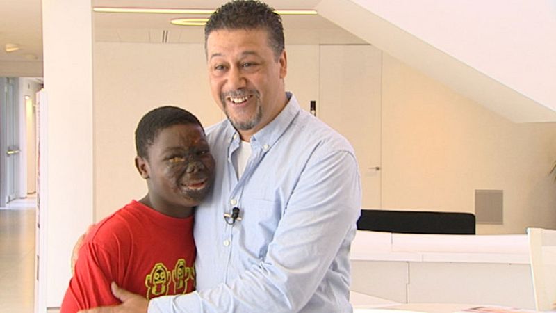 La solidaridad ha hecho posible la reconstrucción en Barcelona del rostro de un joven de Guinea Bissau