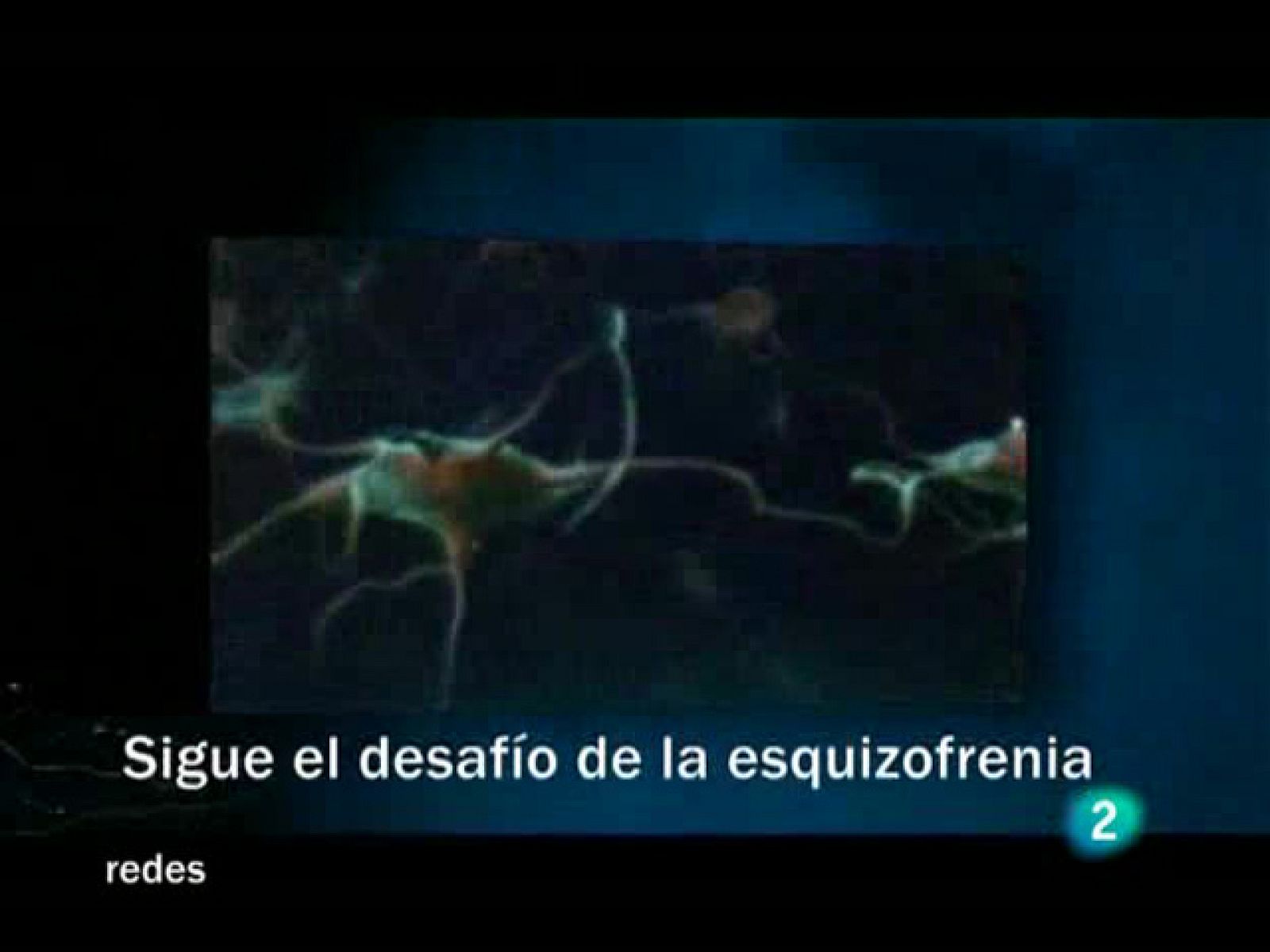 Esquizofrenia ventrículos agrandados Esquizofrenia ventrículos agrandados