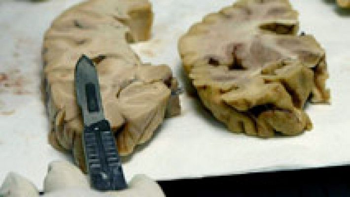 Telediario 1 - Una proteína asociada al alzheimer podría transferirse por contaminación del material quirúrgico