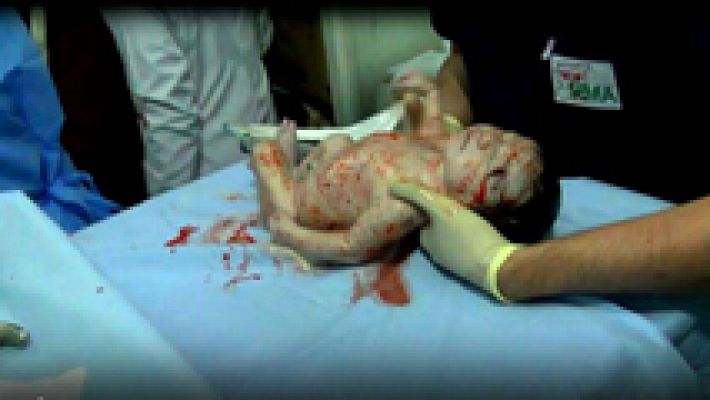 Telediario 1 - Amal, la niña siria que nació marcada por la metralla