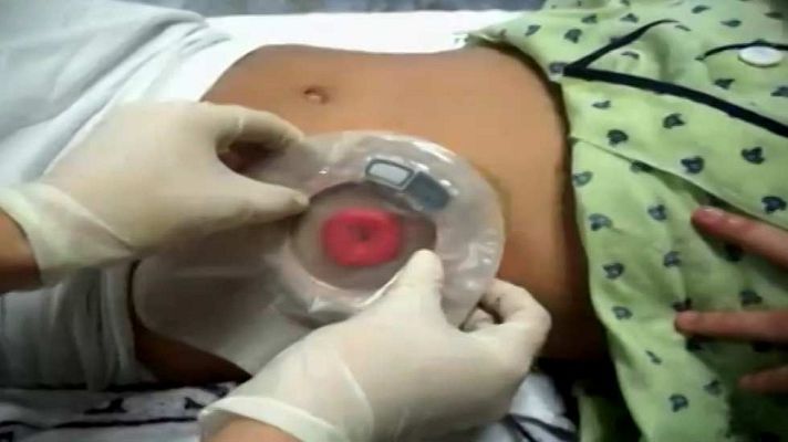 Telediario 1 - Se celebra el Día Mundial de los pacientes con estoma