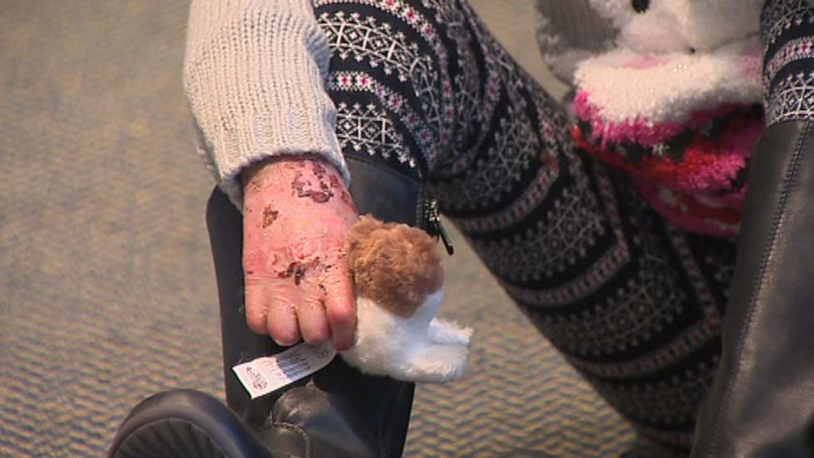 Los médicos esperan que en una década haya una terapia con células madre para los enfermos con 'piel de mariposa'