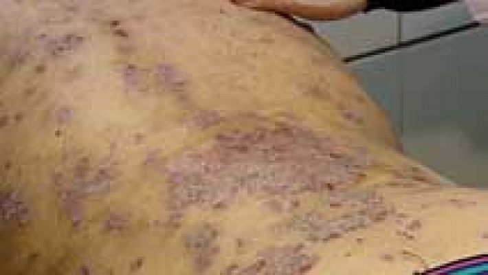 Más de un millón de españoles tiene psoriasis