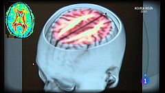 Ictus y riesgos cerebrales
