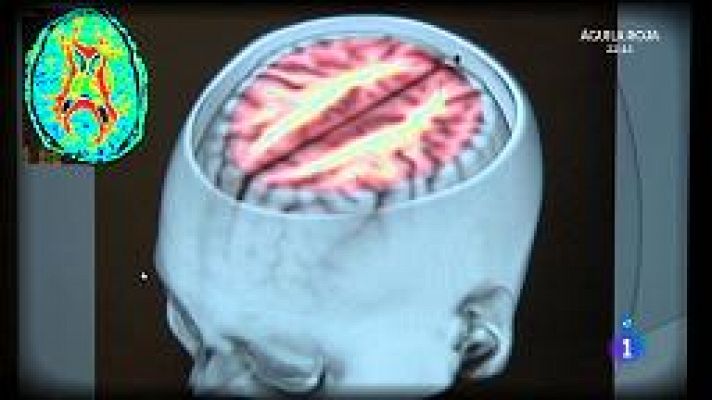 La mañana - Ictus y riesgos cerebrales