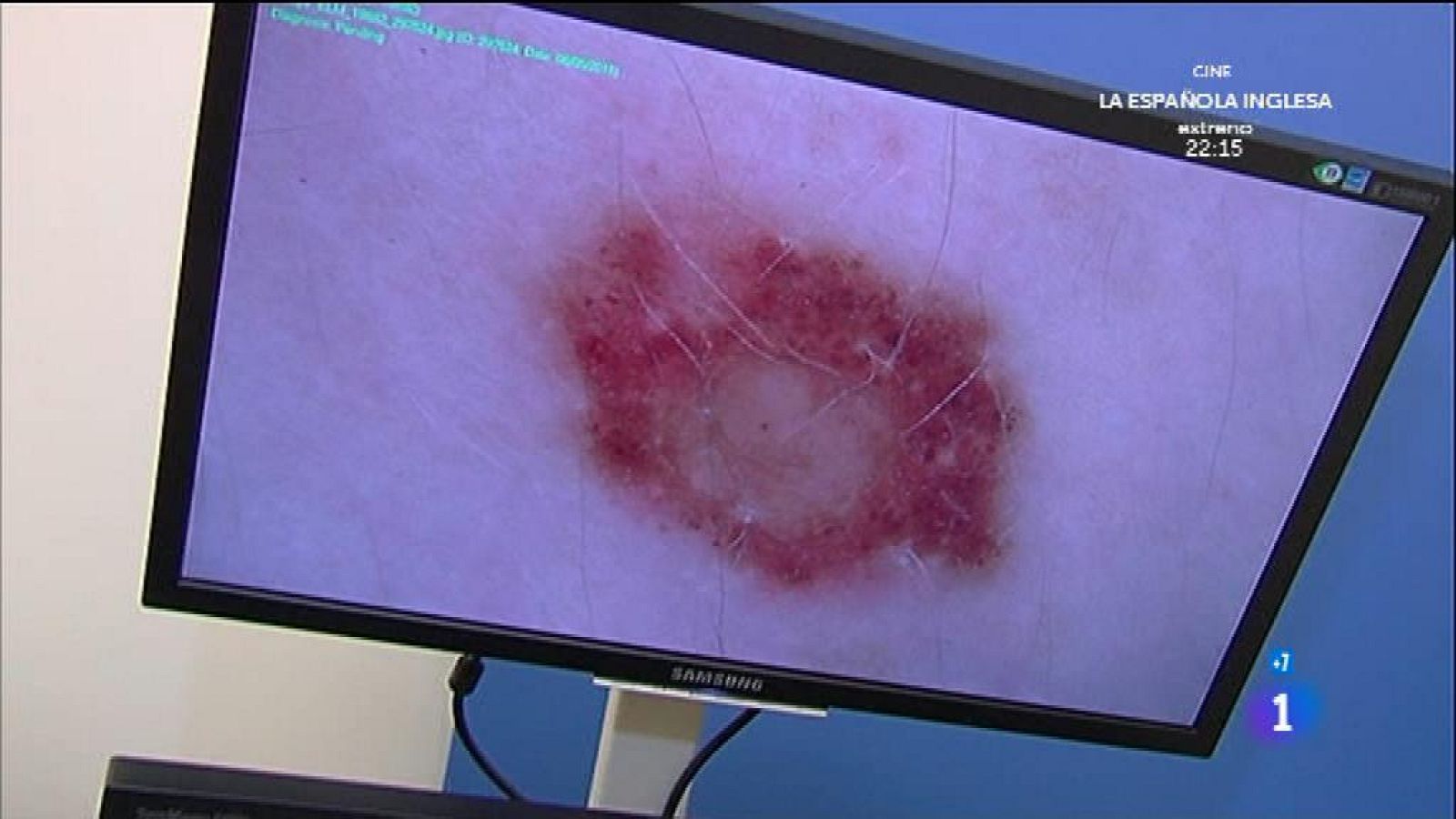 Aprendemos a revisar los lunares