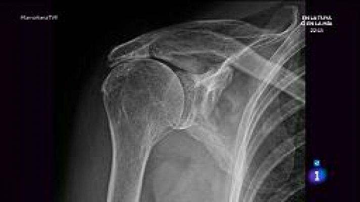 La mañana - Dolor de hombro ¿cómo aliviarlo?