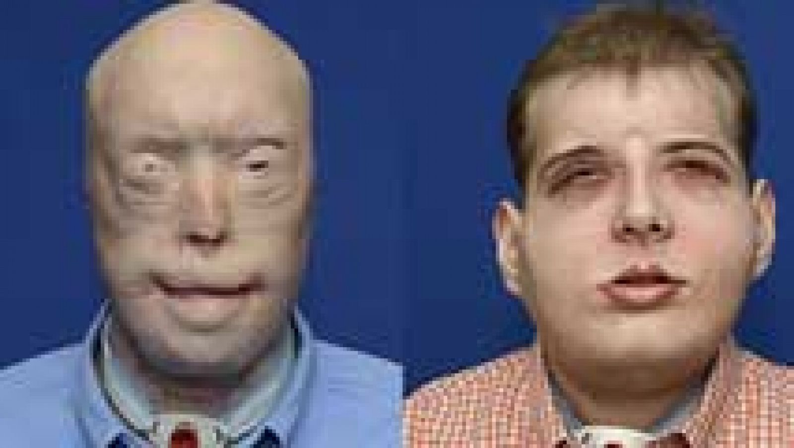 Telediario 1: Llevan a cabo en Nueva York el trasplante de cara más complejo hasta la fecha | RTVE Play