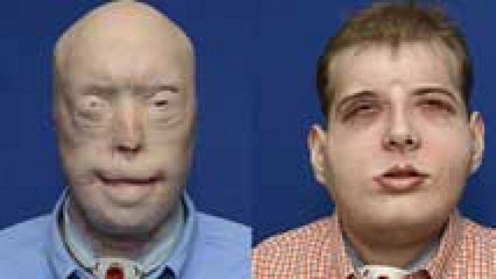 Llevan a cabo en Nueva York el trasplante de cara más complejo hasta la fecha