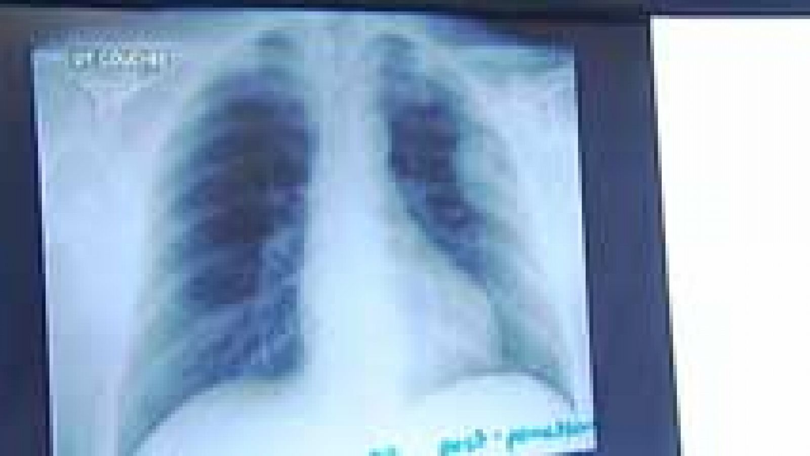 Telediario 1: La comunidad científica busca respuestas al cáncer de pulmón | RTVE Play