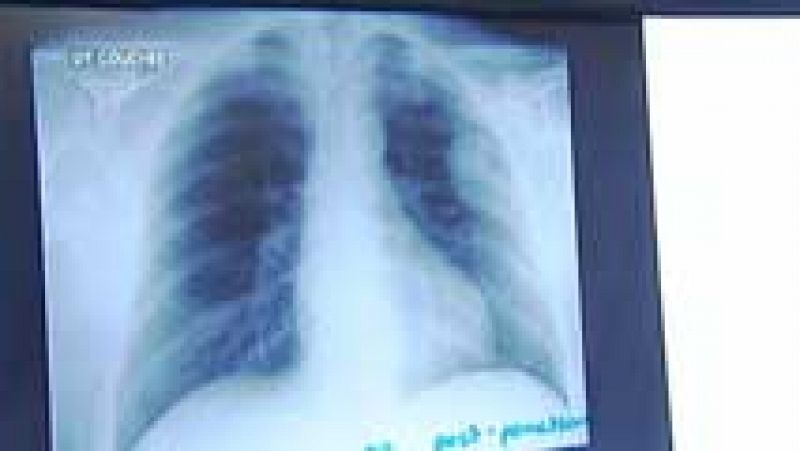 La comunidad científica busca una respuesta, en factores hormonales, ambientales o genéticos al cáncer de pulmón