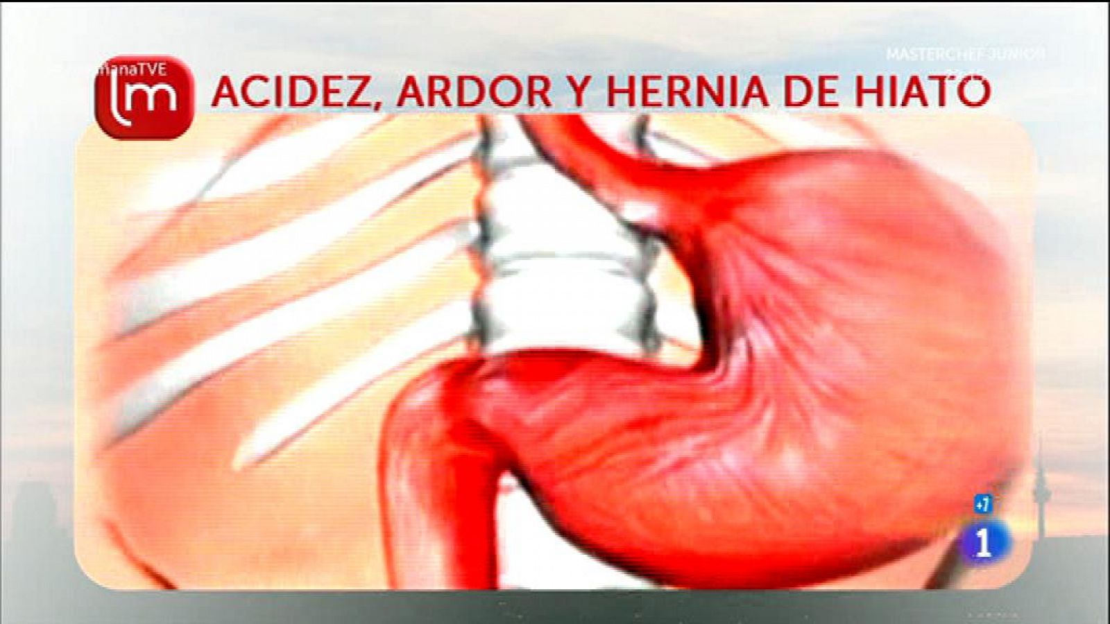 Acidez de estómago y hernia de hiato