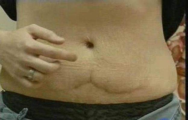 Reporteros del Telediario - Los peligros de la cirugía estética