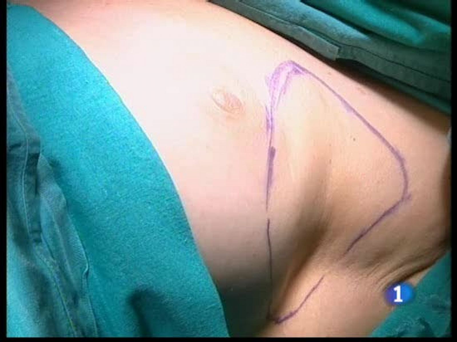 En un hospital de Madrid han implantado células madre adultas para reconstruir la mama de cinco mujeres con cáncer
