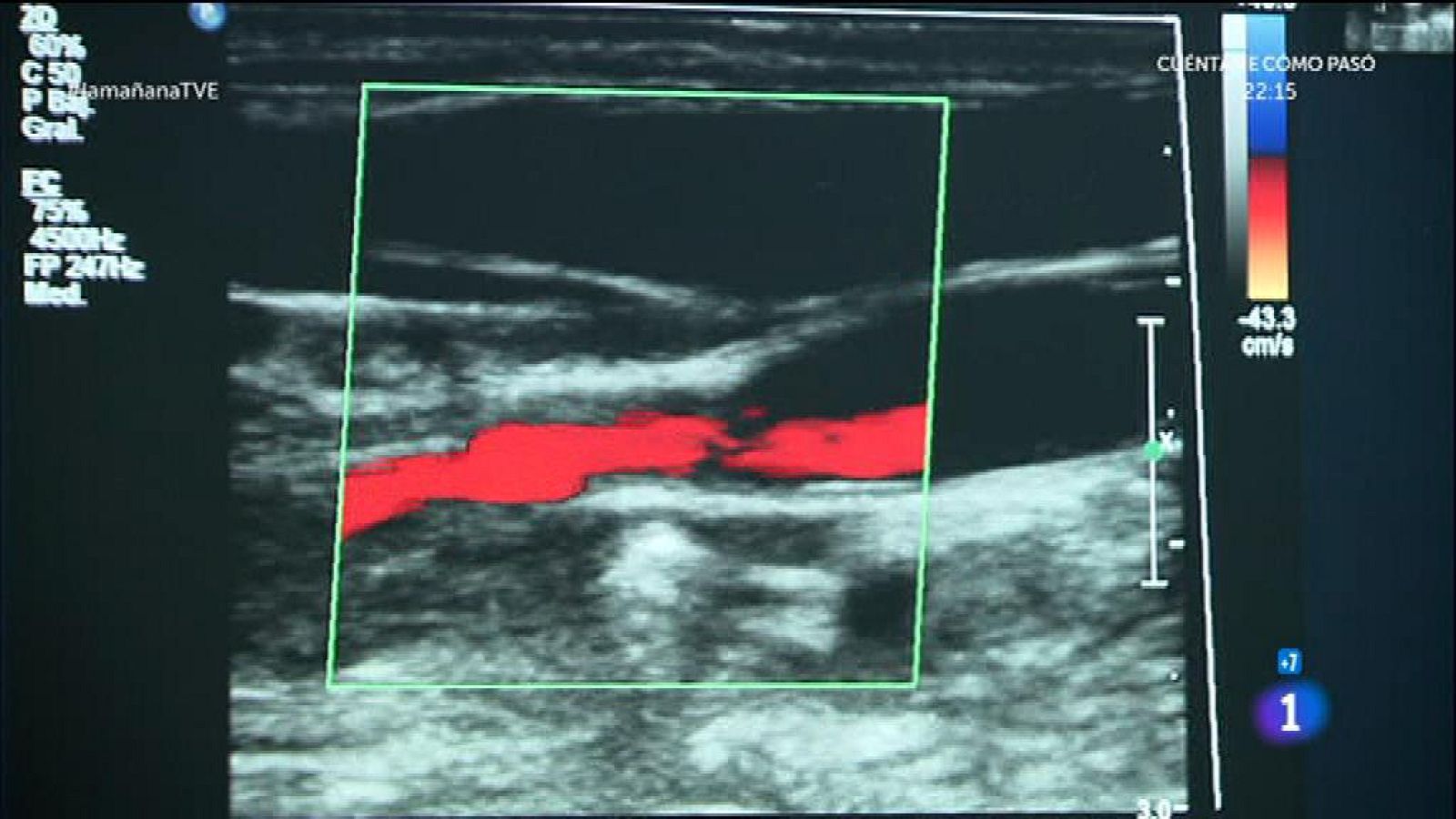 Lesión cerebral evitable