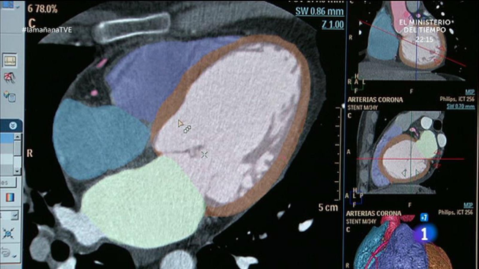 Herencia y predisposición en el corazón
