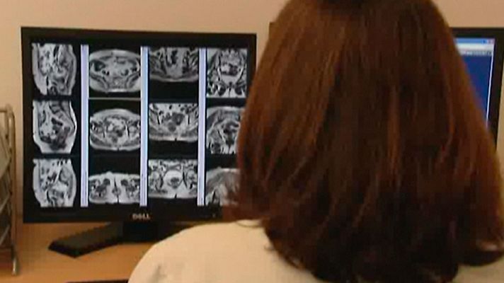 Telediario 1 - Uno de cada veinte españoles padecerá cáncer de colón a lo largo de su vida