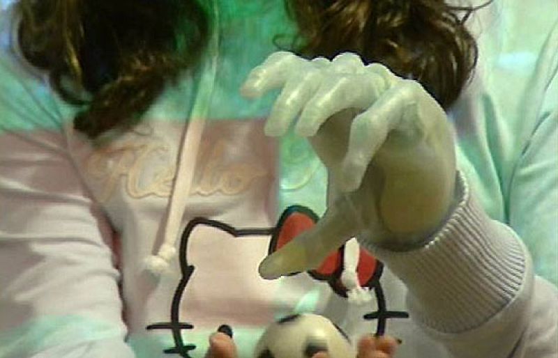 Implantan una mano biónica a una adolescente