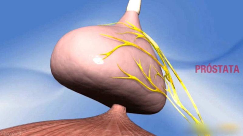 Se celebra el Día Mundial del cáncer de próstata, el tumor más frecuente entre los hombres 