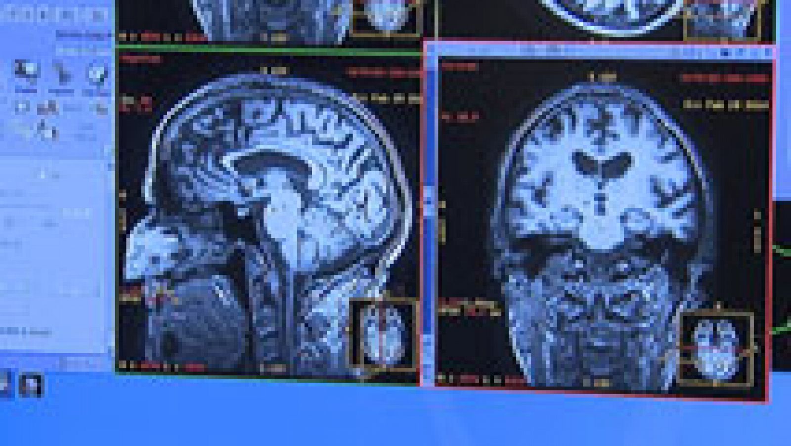 La preocupación principal de los enfermos de esquizofrenia es quedarse solos y ser rechazado por la sociedad