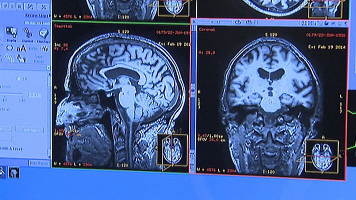 Telediario 1 - La preocupación principal de los enfermos de esquizofrenia es quedarse solos y ser rechazado por la sociedad