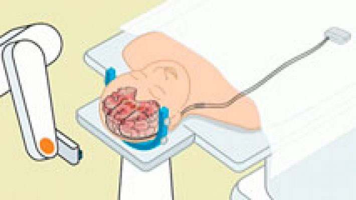 Telediario 1 - Pionero trasplante en Barcelona para mejorar los efectos de la distonía