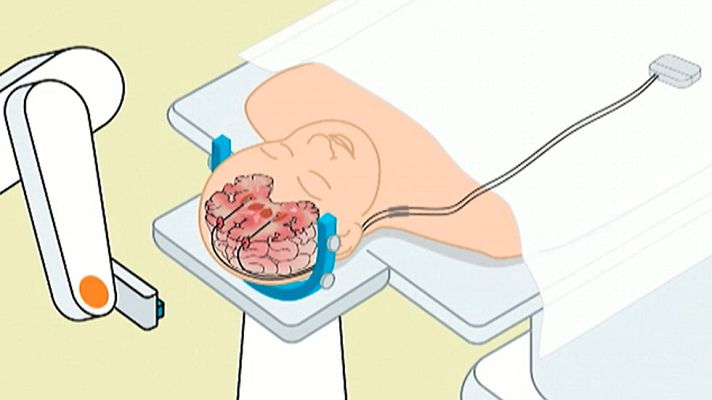 Telediario 1 - Pionero trasplante en Barcelona para mejorar los efectos de la distonía