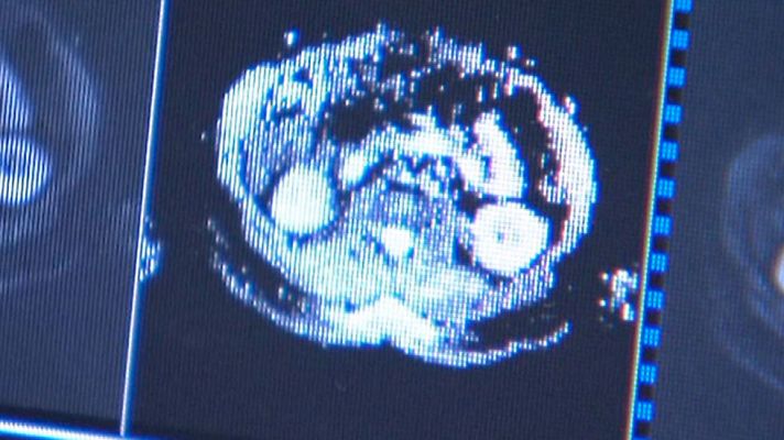 Telediario 1 - Cada año 2.000 personas son diagnosticadas de mieloma múltiple