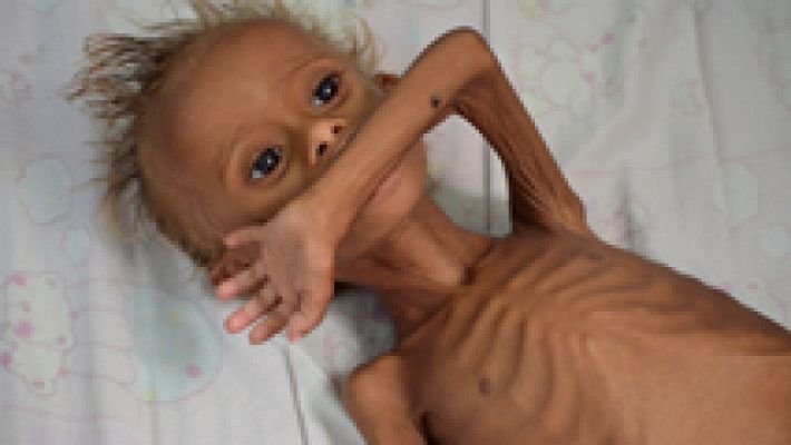 La hambruna, una de las peores consecuencias de la guerra