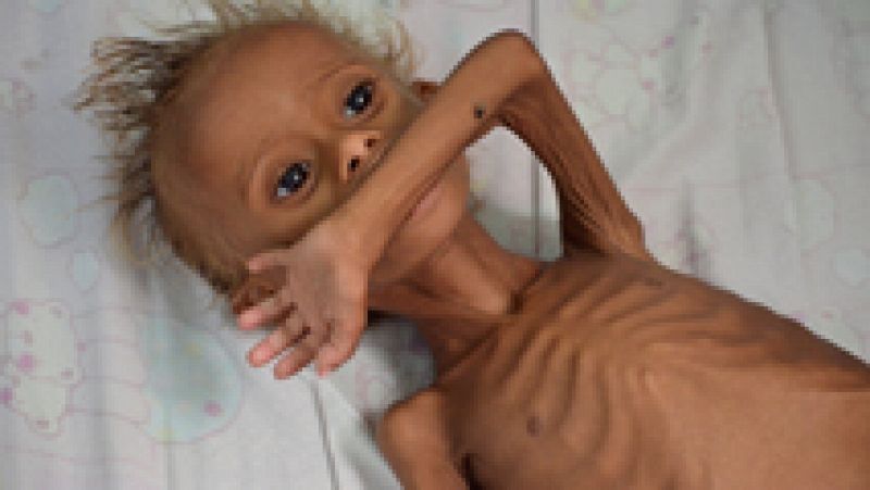La hambruna, una de las peores consecuencias de la guerra en Yemen