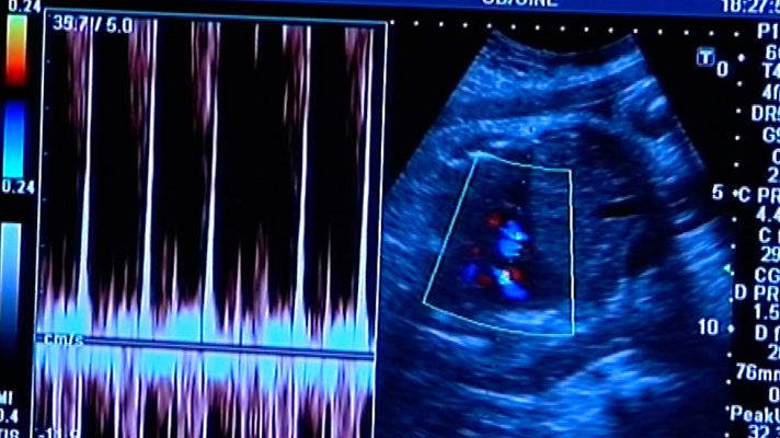Telediario 1 - Pregorexia: una conducta alimentaria con consecuencias graves en el embarazo