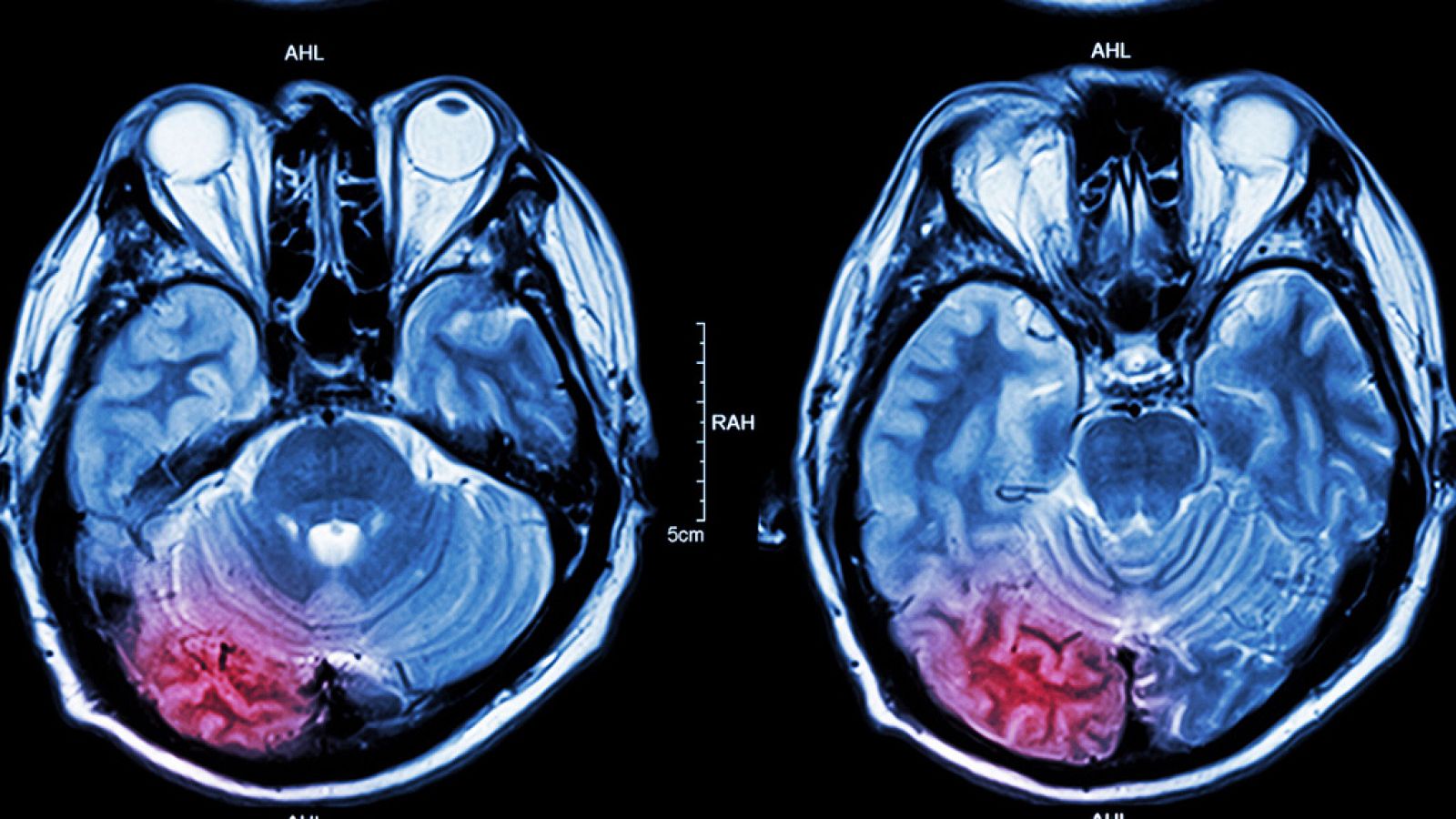 Aumenta la incidencia del ictus en pacientes jóvenes