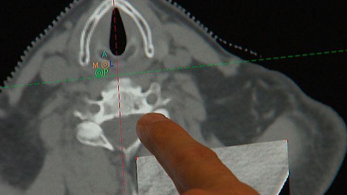 Telediario 1 - El cáncer de pulmón sigue siendo el más mortífero en España