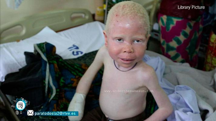 Para todos La 2 - Reportaje sobre el albinismo en África