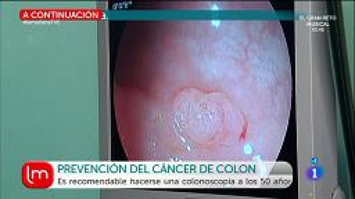 Cáncer de colon