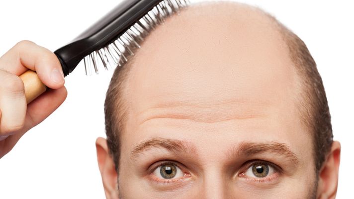 Telediario 1 - Un equipo de científicos de la Universidad de Edimburgo descubre los 287 genes que inciden en la calvicie