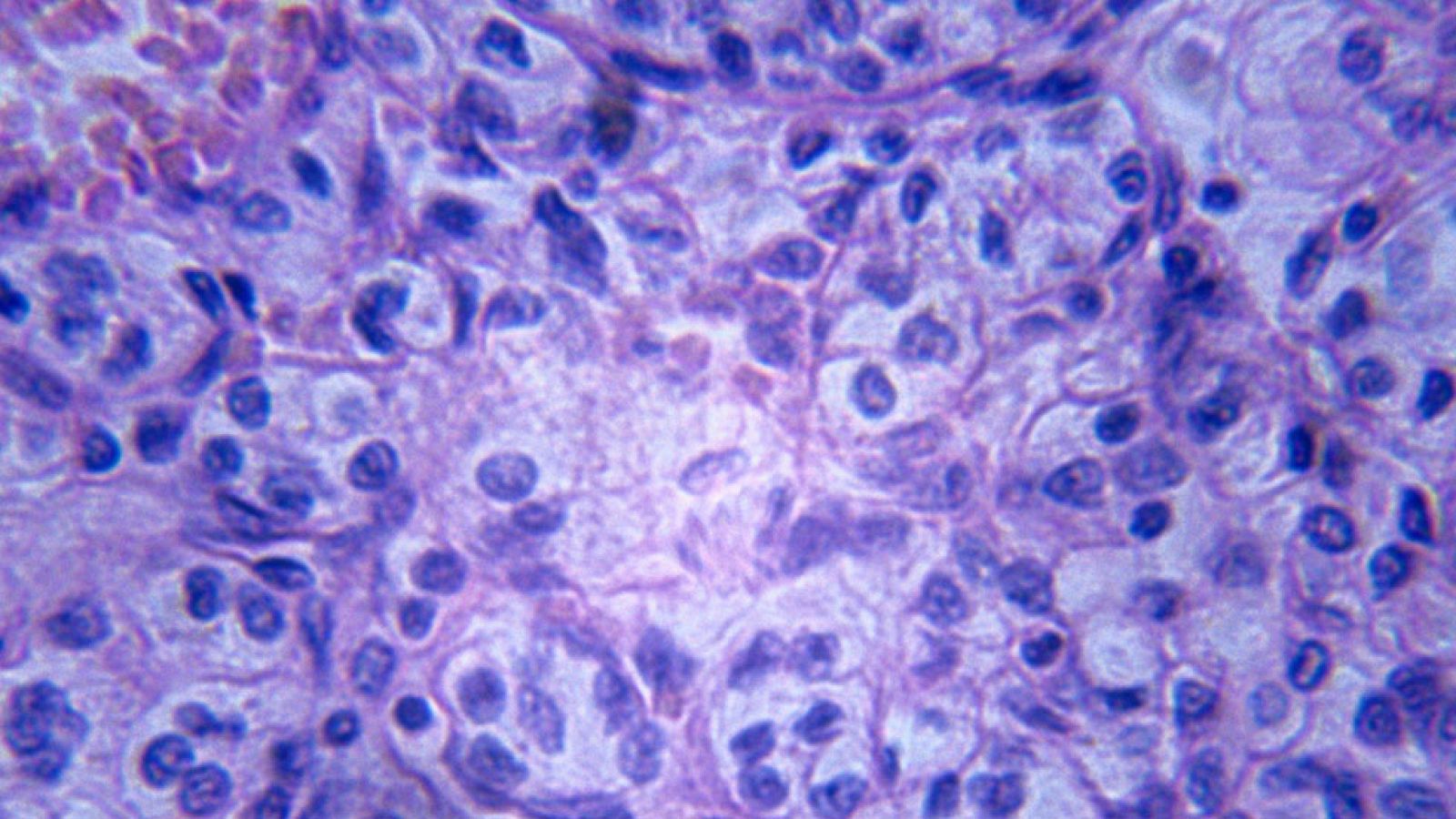 Científicos han desarrollado una molécula que consigue reducir a la mitad el riesgo de progresión de un cáncer de pulmón muy poco frecuente: se da en gente joven y que en muchos casos no fuma. Se ha dado a conocer en Chicago en la reunión anual de la