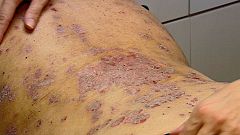 Un proyecto de realidad virtual para derribar prejuicios sobre la psoriasis