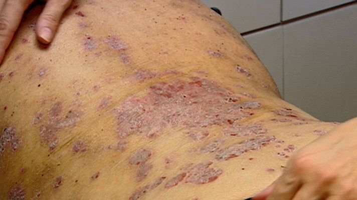 Telediario 1 - Un proyecto de realidad virtual para derribar prejuicios sobre la psoriasis