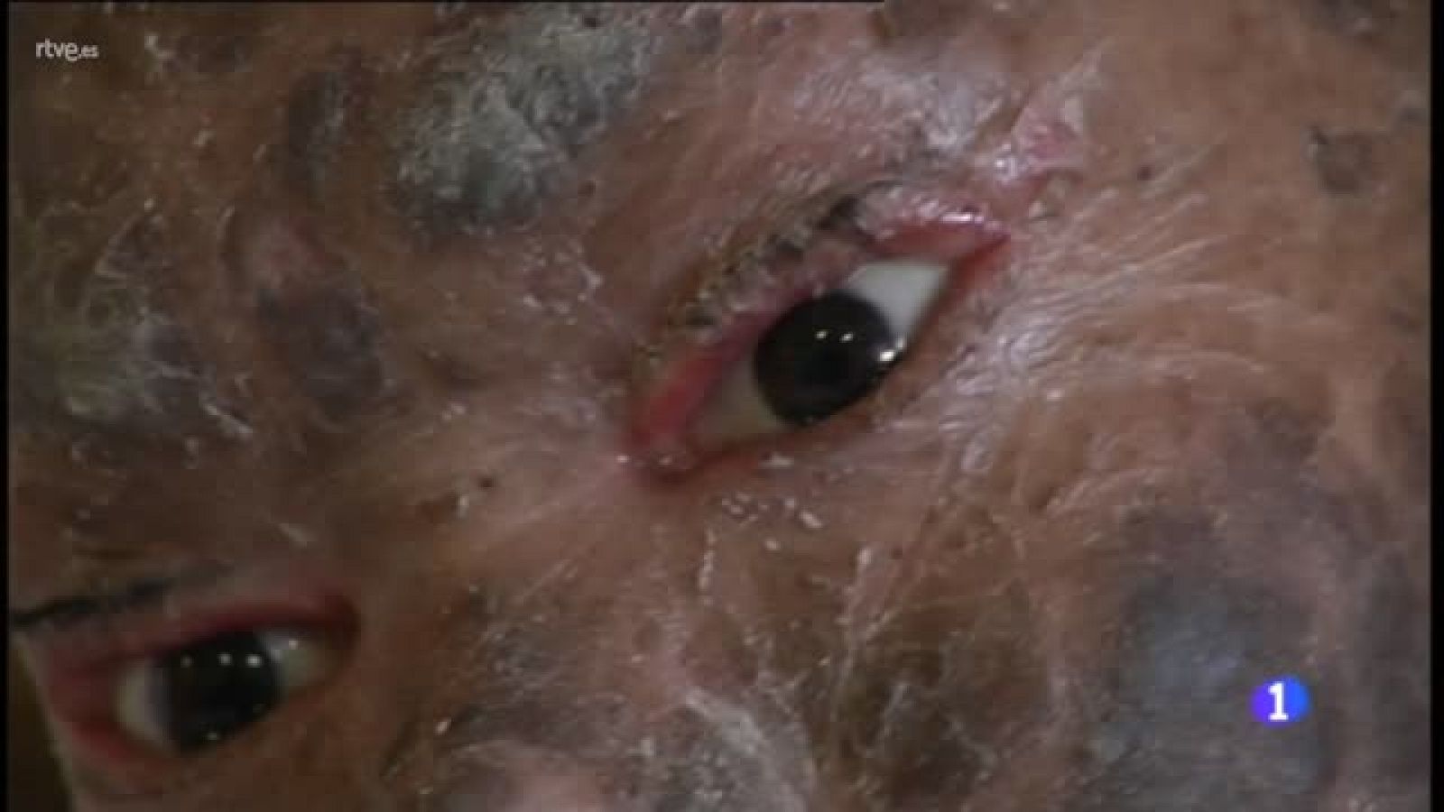 Médicos malagueños tratan a una joven india de una extraña enfermedad de la piel | Ver