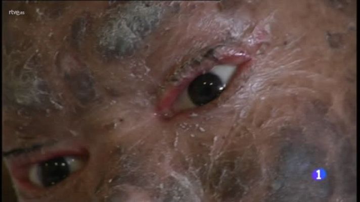  - Médicos malagueños tratan a una joven india de una extraña enfermedad de la piel