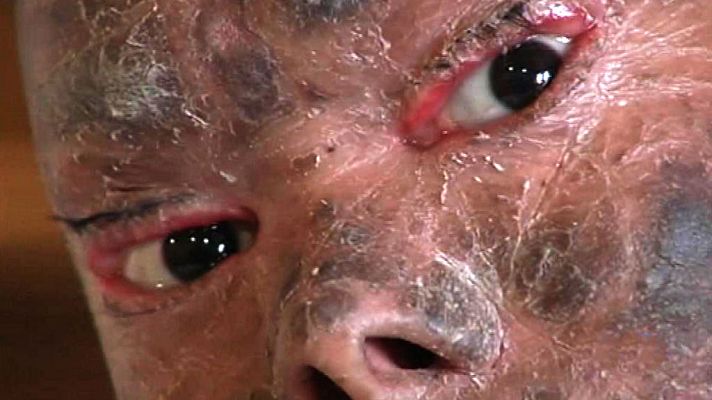 Telediario 1 - En  Málaga está siendo tratada una chica india de una extraña enfermedad genética que le hace mudar la piel cada 45 días